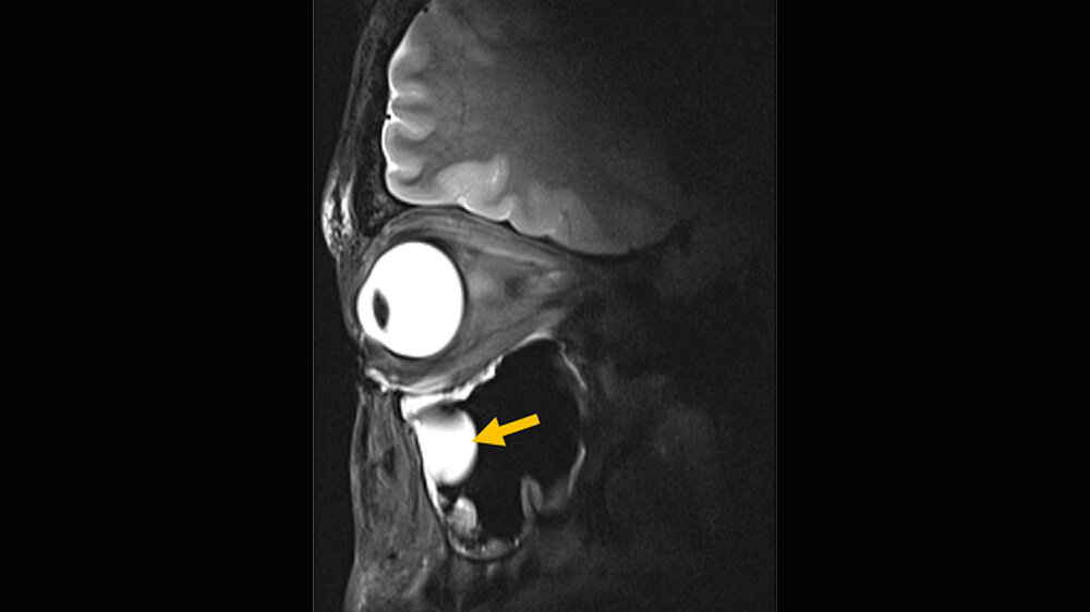 MRT-Scan.jpg MRT des Schädels mit Fokus auf der Augenhöhle, gelber Pfeil auf einer Zyste neben der linken Augenhöhle