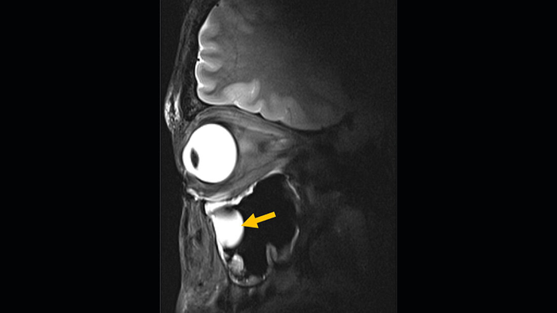 MRT-Scan.jpg MRT des Schädels mit Fokus auf der Augenhöhle, gelber Pfeil auf einer Zyste neben der linken Augenhöhle
