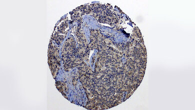 Metastasierte_Prostatakarzinomzellen_Muderslab.jpg Metastasierte Prostatakarzinomzellen