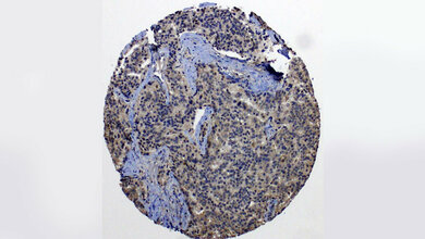 Metastasierte_Prostatakarzinomzellen_Muderslab.jpg Metastasierte Prostatakarzinomzellen