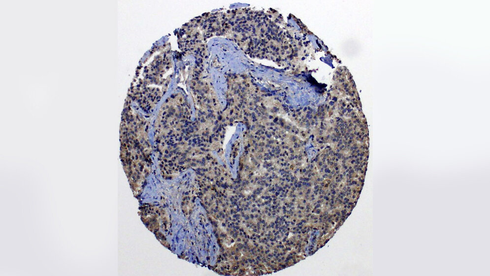 Metastasierte Prostatakarzinomzellen 