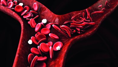 Grafische Darstellung der Sichelzellen in einem Blutgefäß