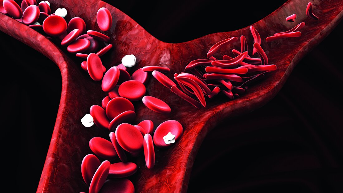 Grafische Darstellung der Sichelzellen in einem Blutgefäß