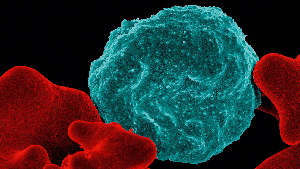 Immunchromatographische Malariaschnelltests Laboratoriumsmedizin