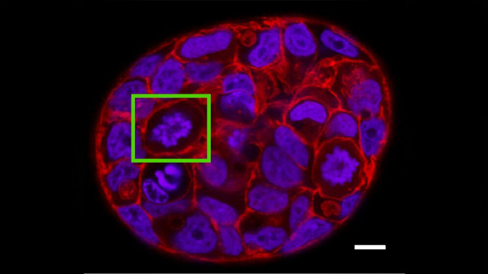 Mini-Tumor aus menschlichen Brustkrebszellen 