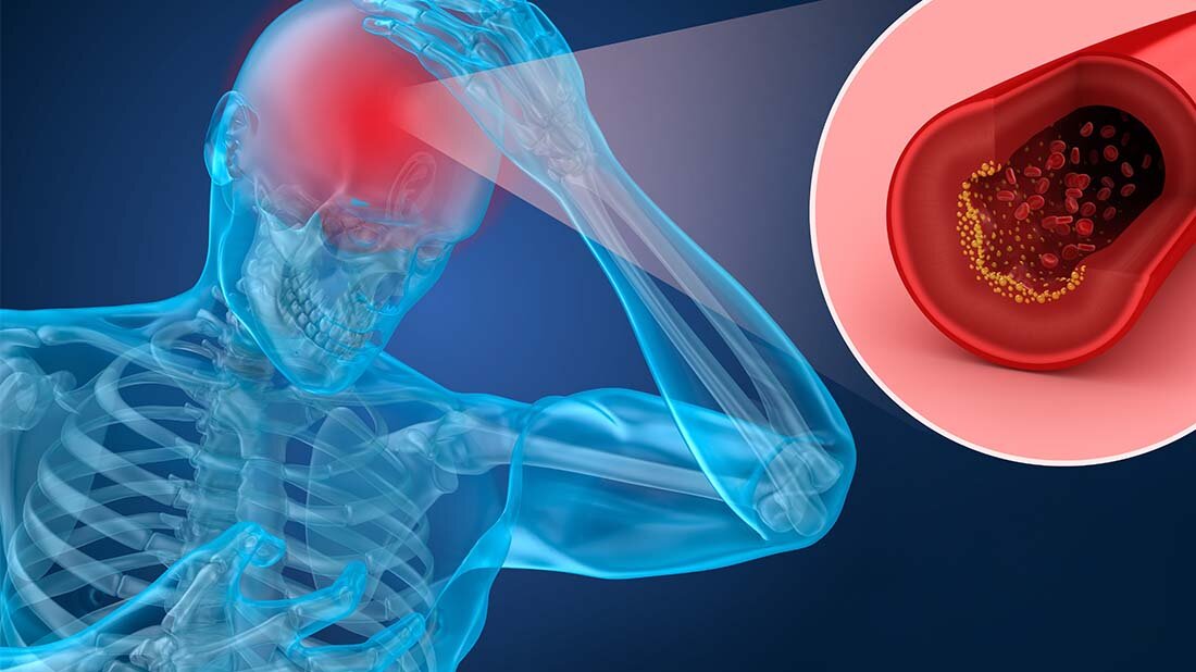 Schlaganfall_online-1.jpg Prognostischer Effekt mobiler Stroke Units