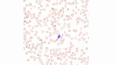 Titelbild zum Fachbeitrag über Myelodysplastische Syndrome (Teil 1)