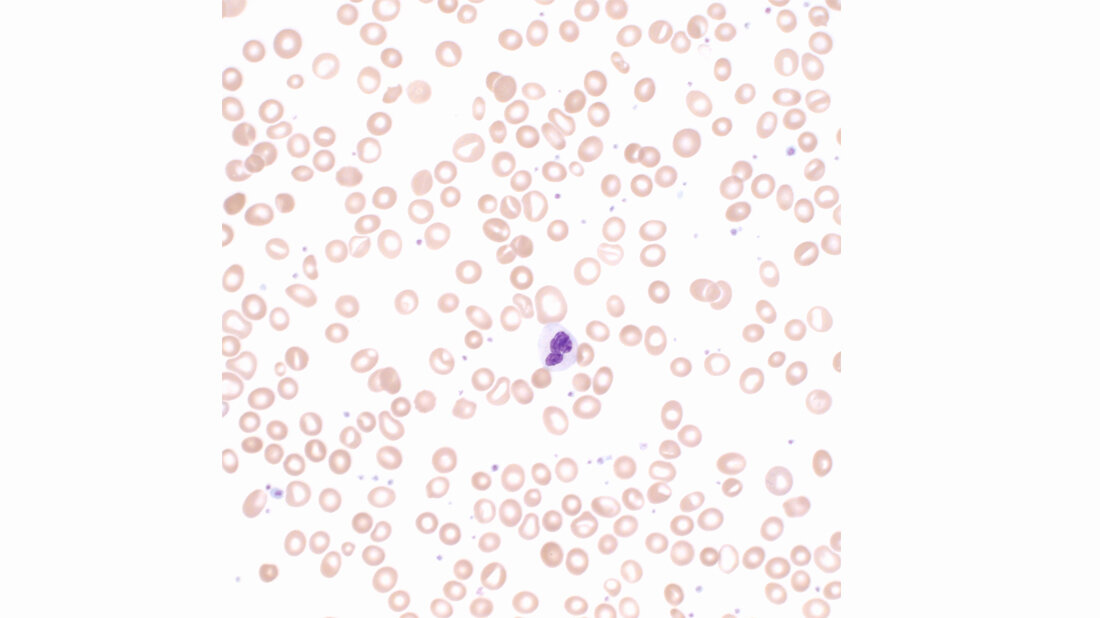 Titelbild zum Fachbeitrag über Myelodysplastische Syndrome (Teil 1)