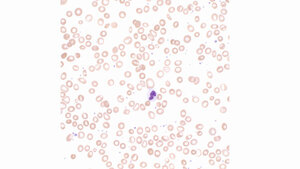 Titelbild zum Fachbeitrag über Myelodysplastische Syndrome (Teil 1)