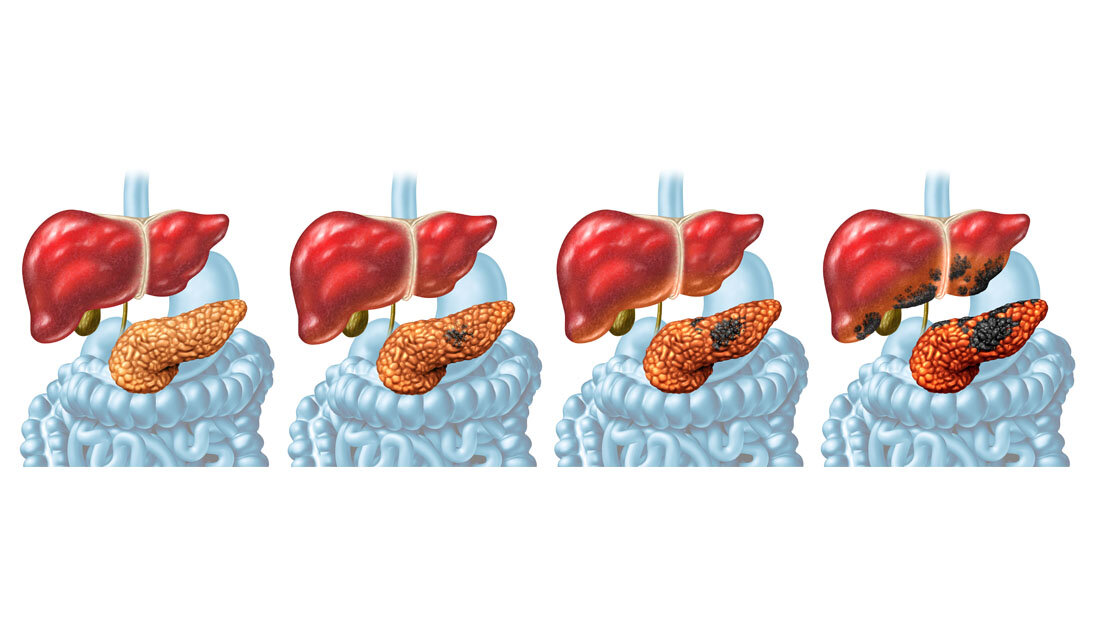 Stadien beim Pankreaskarzinom