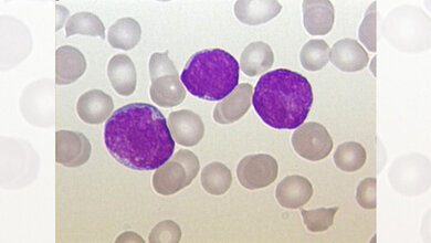 Akute lymphoblatische Leukämie