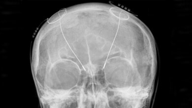 Tiefe Hirnstimulation