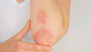 Photo of elbow with psoriasis