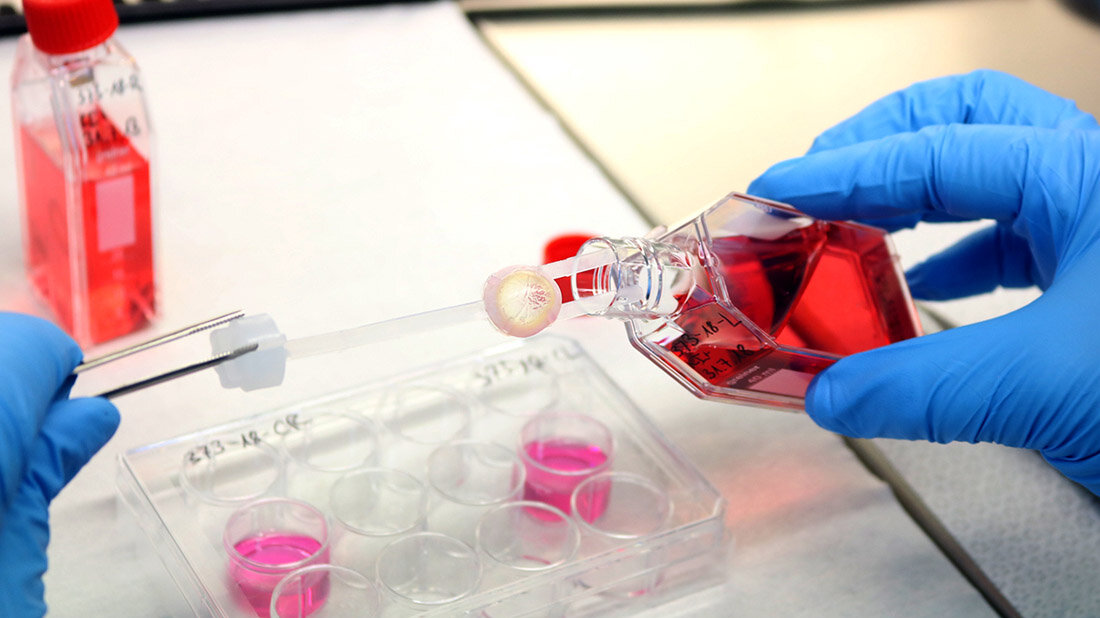 Hornhautprozessierung nach Gewebespende.