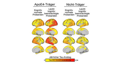 Alzheimer_APOE-e4-Variante.jpg Wer die APOE-e4-Variante in den Genen trägt, braucht ggf. eine frühere medikamentöse Therapie.