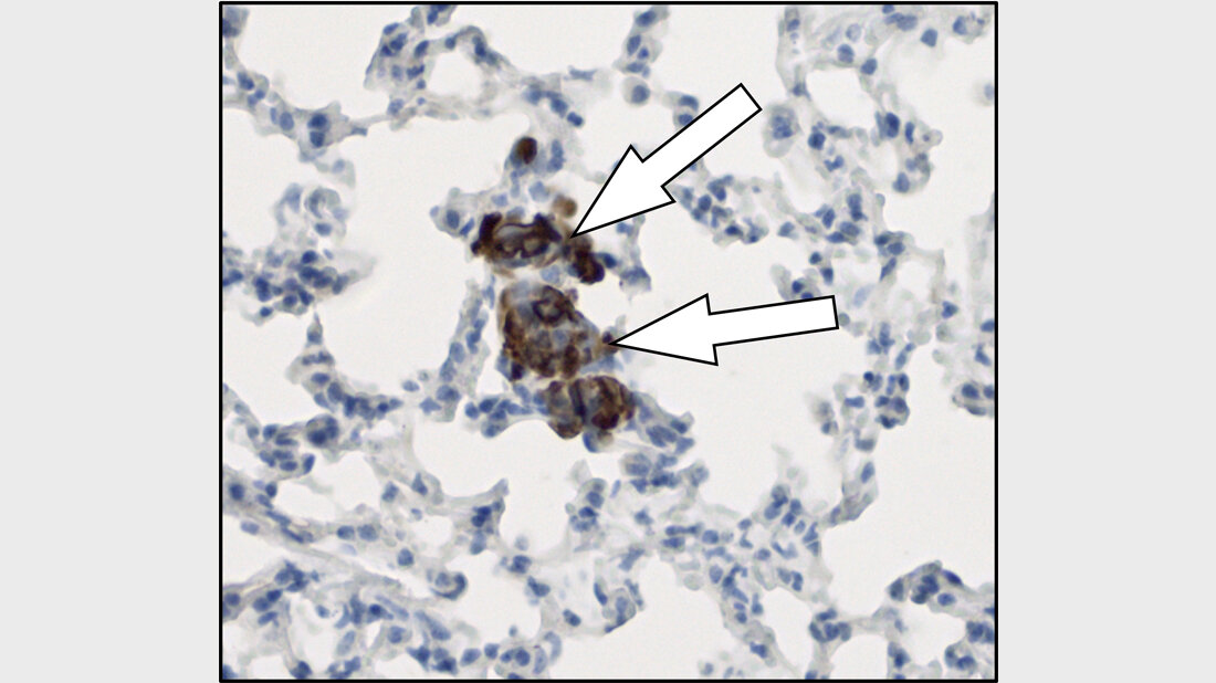 Brustkrebszellen (braun dargestellt) sind in die Lunge eingewandert 