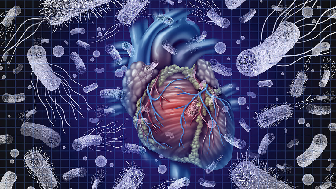 Grafische Visualisierung einer Endokarditis 