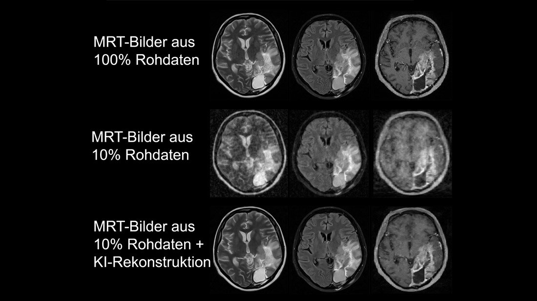 MRT-Bilder eines Hirntumors im Vergleich