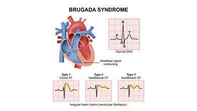 Infografik zum Brugada-Syndrom: Herzreizleitung und drei typische EKG-Veränderungen