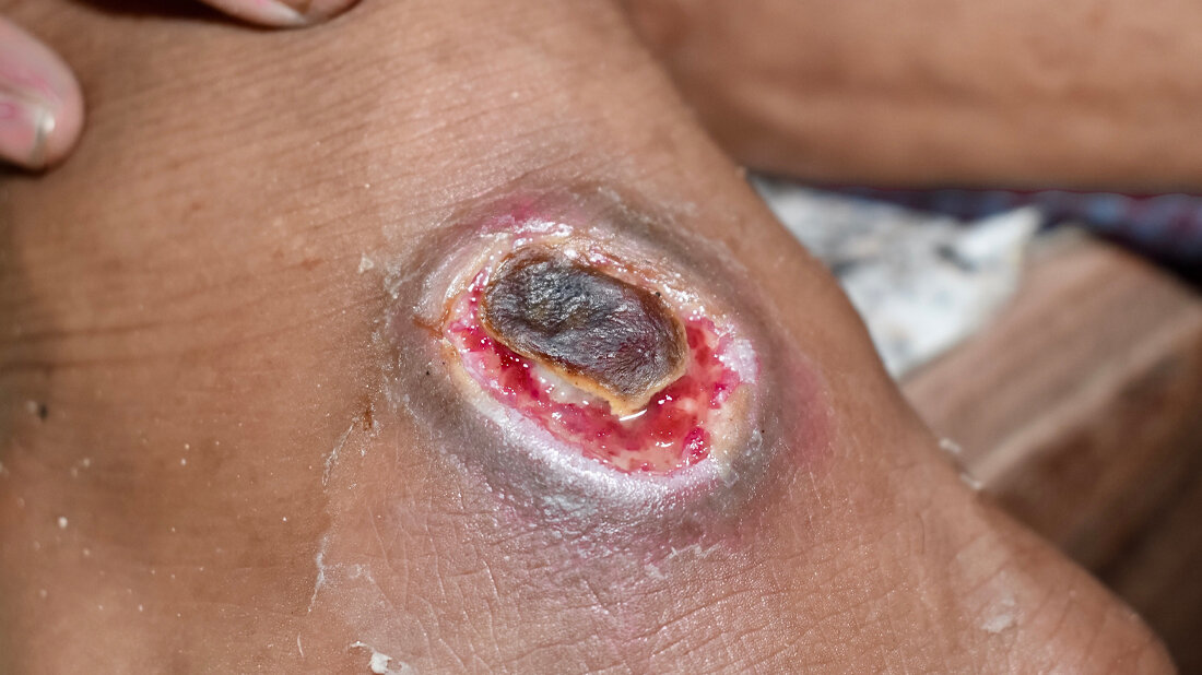 Chronische Wunde