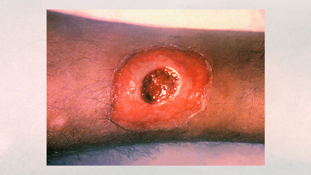 Eine diphtherische Hautläsion am Bein