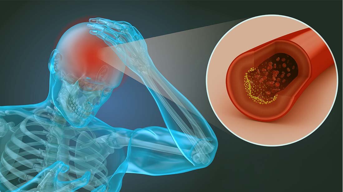 Rezidiv-Prophylaxe ist laut der neuen Leitlinien das A und O. 