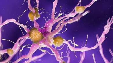 Amyloid-Plaque