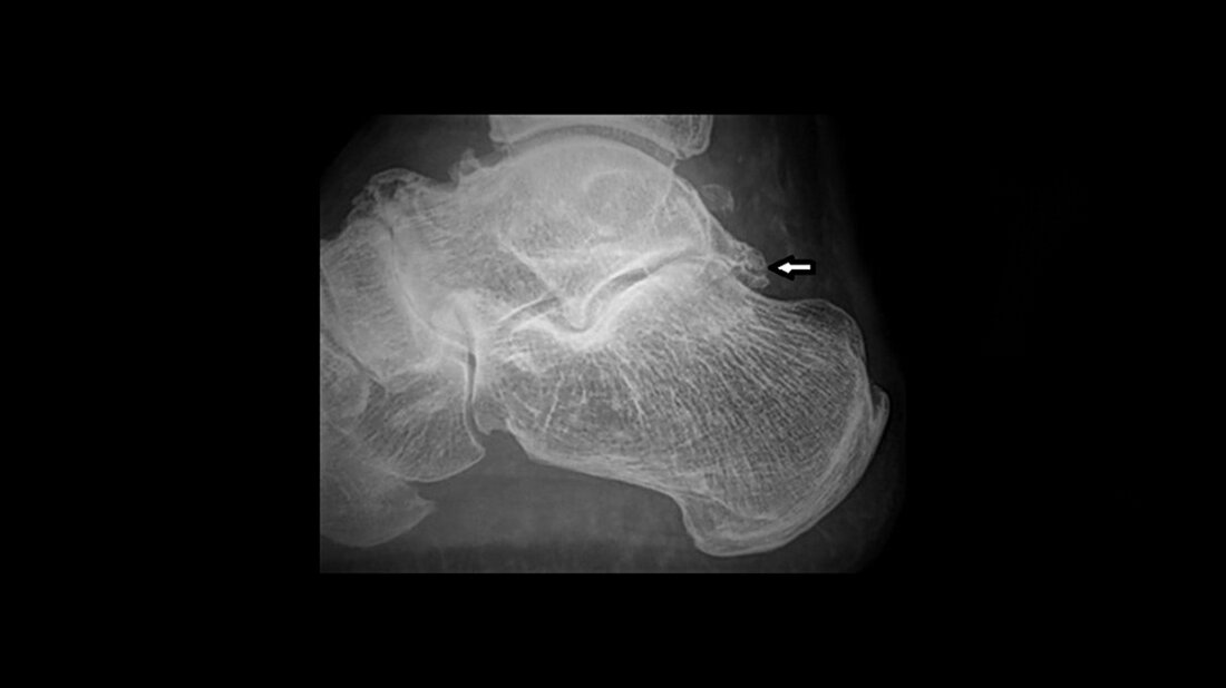 Röntgenaufnahme des Sprunggelenks seitlich