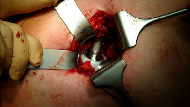 Minimal-invasive Hüftgelenk-Operation