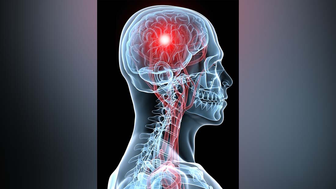 Schlaganfall_herz_online.jpg 11,1 Prozent der Schlaganfallpatienten entwickelten im Monat nach dem Schlaganfall erstmals ein akutes Koronarsyndrom.