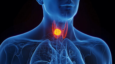 Nachweis prognostisch relevanter
TERT-Promotermutationen
bei Schilddrüsenkarzinomen (Teil 1) Grafische Darstellung der Schilddrüse mit Karzinom