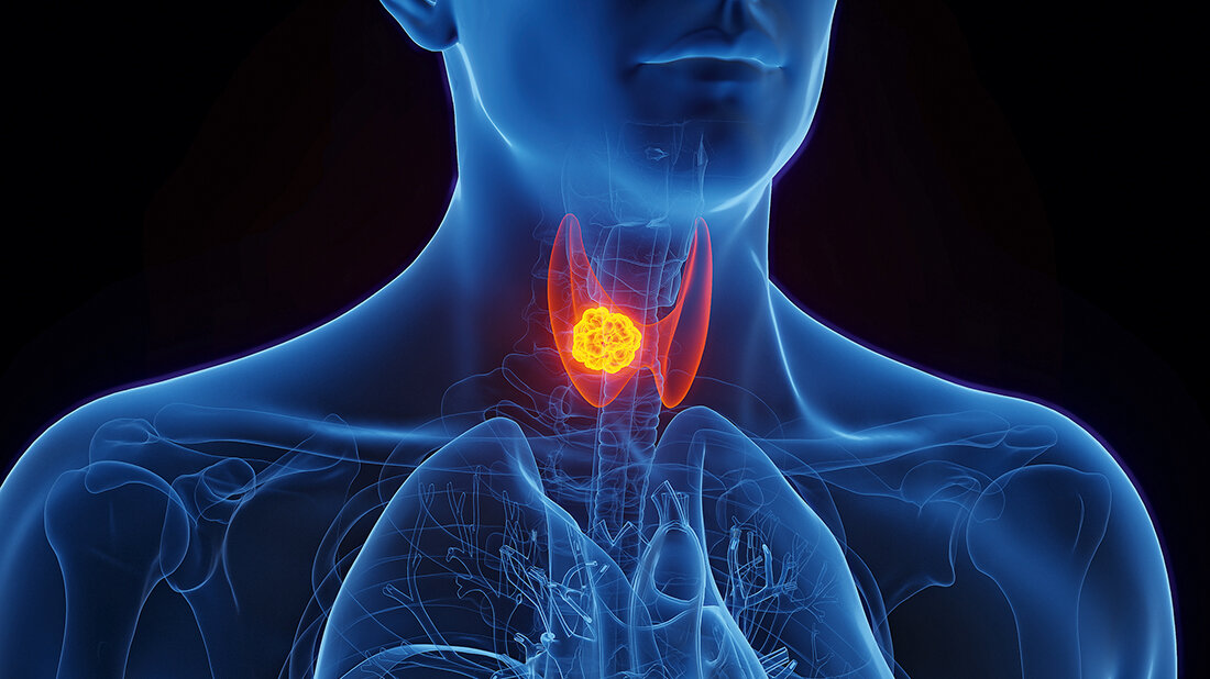 Grafische Darstellung der Schilddrüse mit Karzinom