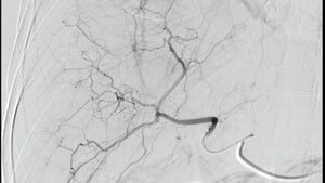 Titelbild des Fachbeitrags zur transarteriellen Chemoembolisation (TACE) der Leber