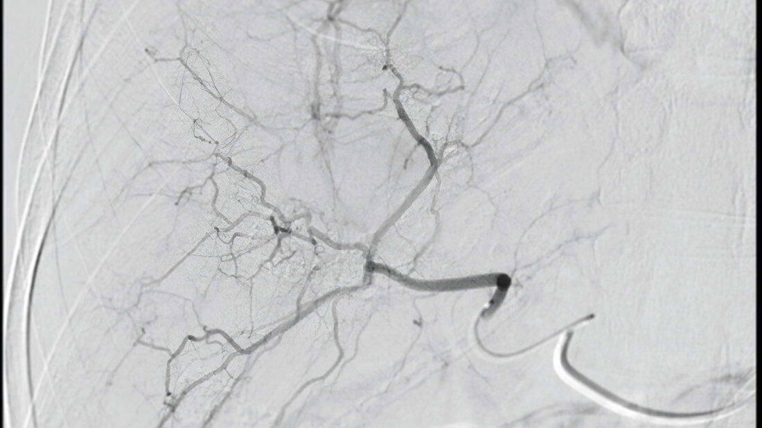 Titelbild des Fachbeitrags zur transarteriellen Chemoembolisation (TACE) der Leber