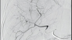 Titelbild des Fachbeitrags zur transarteriellen Chemoembolisation (TACE) der Leber