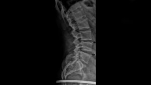 Titelbild zum Fachbeitrag über Bildgebung bei persistierenden Wirbelkörperrandleisten