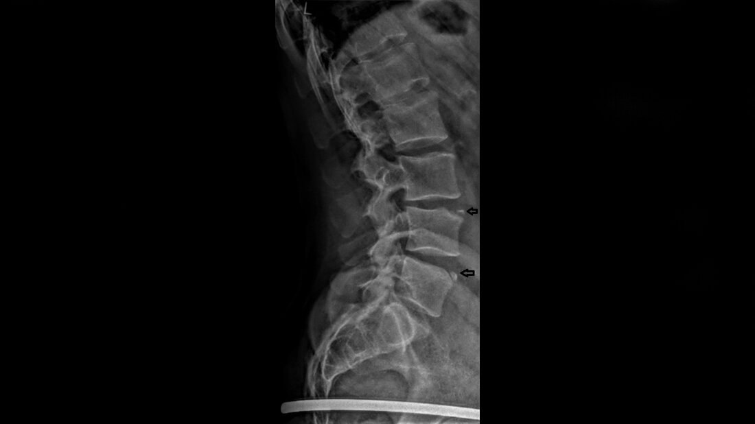 Titelbild zum Fachbeitrag über Bildgebung bei persistierenden Wirbelkörperrandleisten