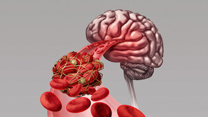 Grafische Darstellung eines Thrombus im Gehirn