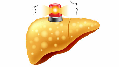 Alarmsignal Fettleber