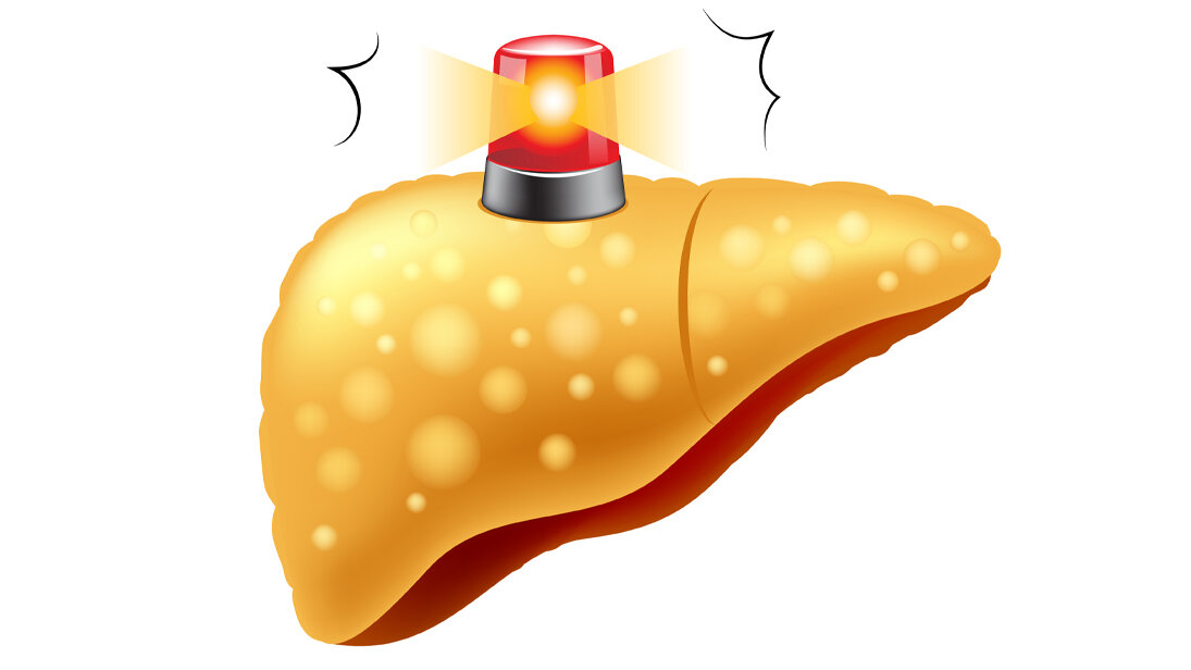 Alarmsignal Fettleber