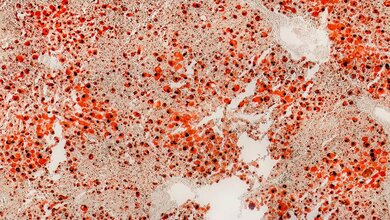 Rund ein Drittel der Erwachsenen hat eine durch Fetteinlagerung vergrößerte Leber – und die Zahl nimmt stetig zu.