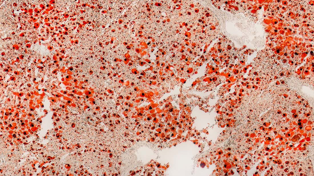 Rund ein Drittel der Erwachsenen hat eine durch Fetteinlagerung vergrößerte Leber – und die Zahl nimmt stetig zu.