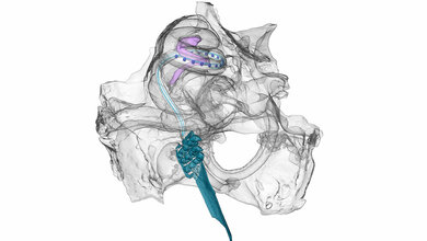 Optisches Cochlea Implantat in der Hörschnecke einer Wüstenrennmaus