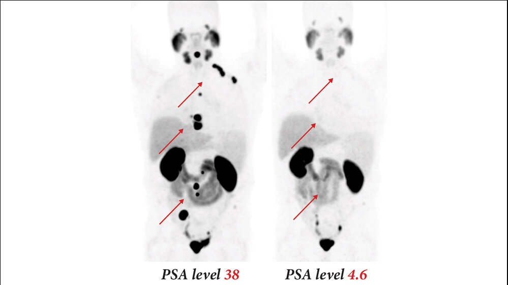 PSMA_617_DKFZ.jpg PMSA-617