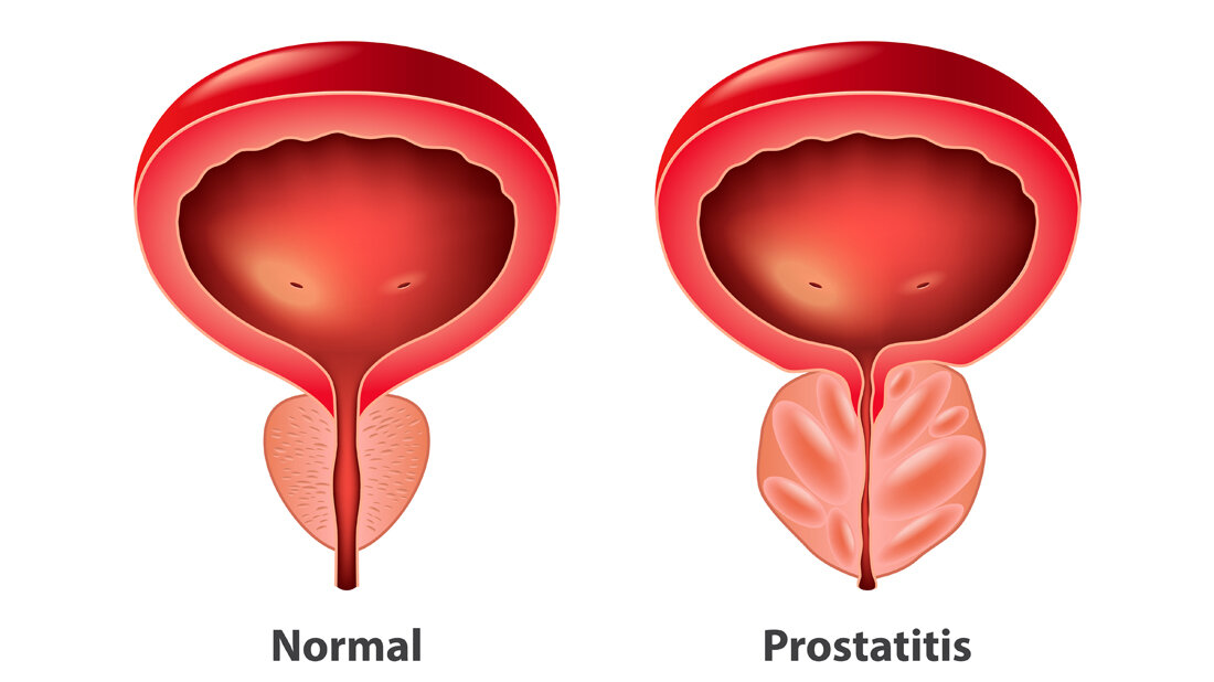 Prostatitis.jpg Schematische Darstellung der Prostata in normal und mit Prostatitis.