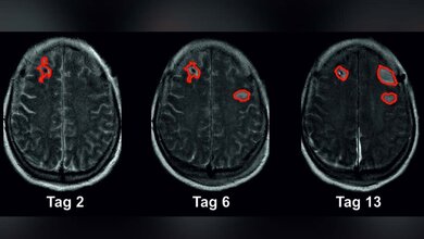 Forschende haben einen Biomarker identifiziert, der ein hohes Risiko für einen drohenden Schlaganfall nach einer Subarachnoidalblutung anzeigt.