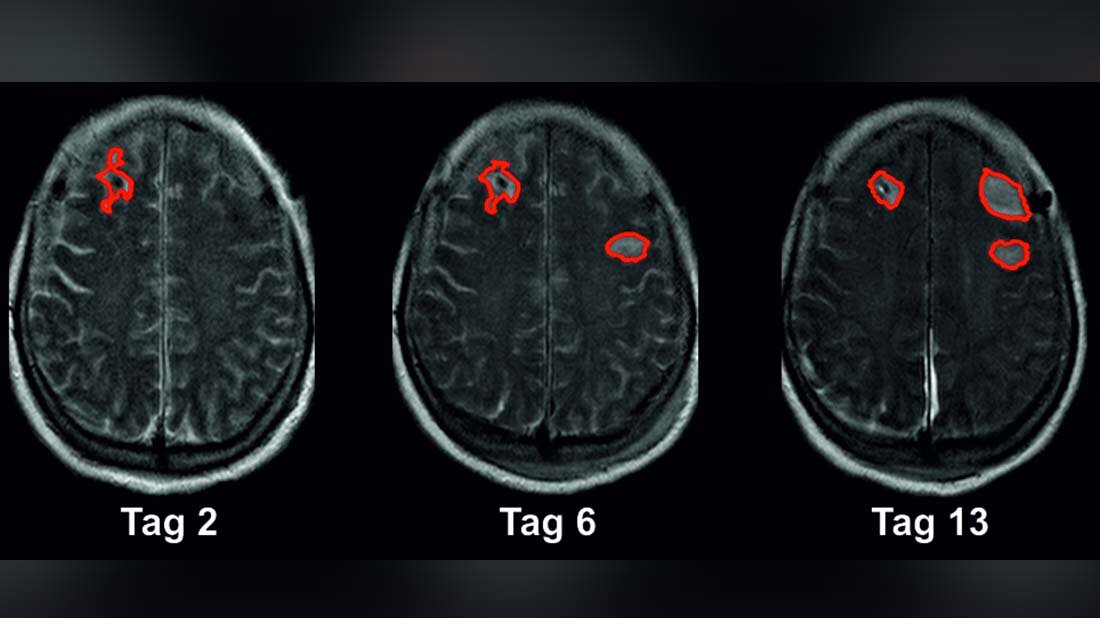 Forschende haben einen Biomarker identifiziert, der ein hohes Risiko für einen drohenden Schlaganfall nach einer Subarachnoidalblutung anzeigt.