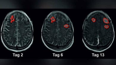Forschende haben einen Biomarker identifiziert, der ein hohes Risiko für einen drohenden Schlaganfall nach einer Subarachnoidalblutung anzeigt.