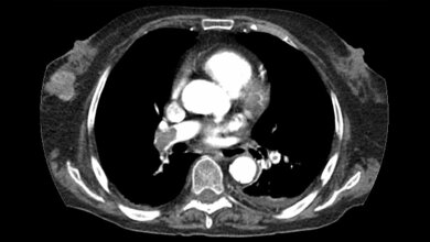 Thorax-CT: Mammakarzinom als Zufallsbefund Titelbild des Fachbeitrags: Fallbericht über den Zufallsbefund Mammakarzinom im Rahmen einer Thorax-CT