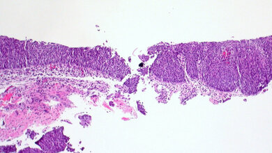 CIN3_Ed_Uthman.jpg CIN3